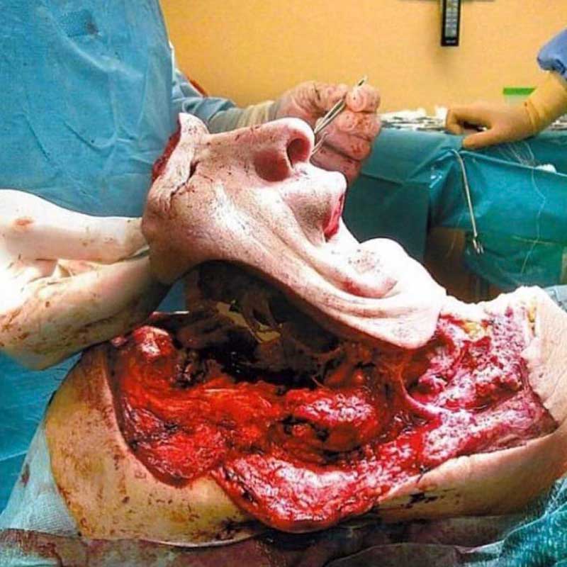 Face removed from donor skull
